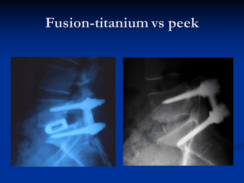 Fusion-titanium vs peek